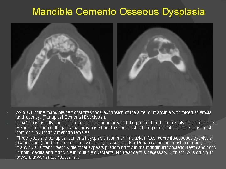 Mandible Cemento Osseous Dysplasia Axial CT of the mandible demonstrates focal expansion of the