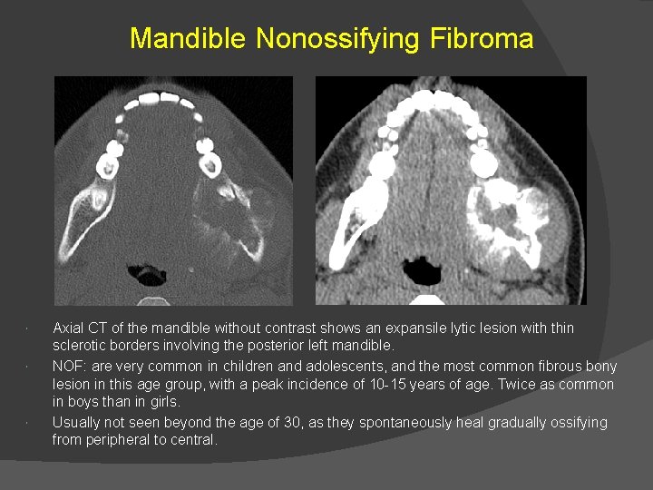Mandible Nonossifying Fibroma Axial CT of the mandible without contrast shows an expansile lytic