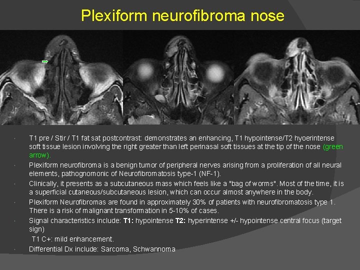 Plexiform neurofibroma nose T 1 pre / Stir / T 1 fat sat postcontrast: