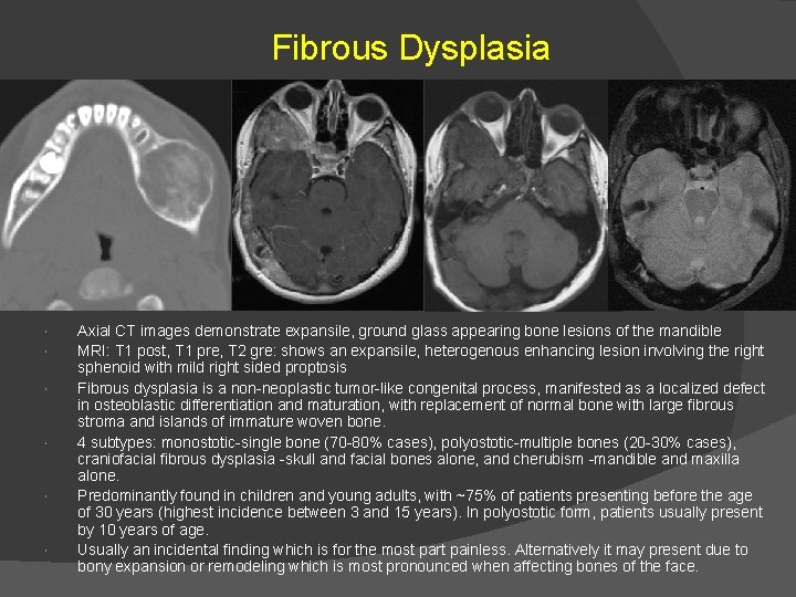 Fibrous Dysplasia Axial CT images demonstrate expansile, ground glass appearing bone lesions of the