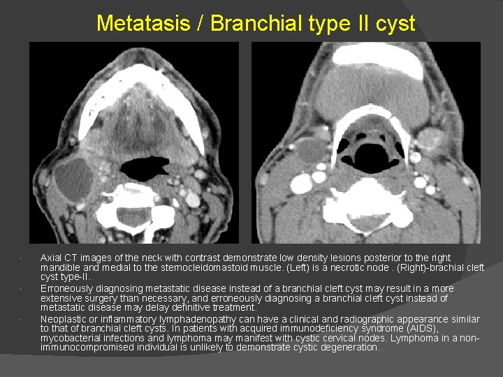 Metatasis / Branchial type II cyst Axial CT images of the neck with contrast