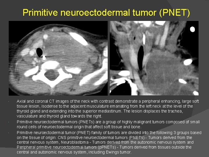 Primitive neuroectodermal tumor (PNET) Axial and coronal CT images of the neck with contrast