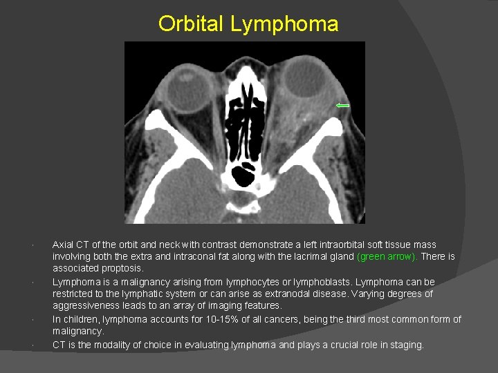 Orbital Lymphoma Axial CT of the orbit and neck with contrast demonstrate a left