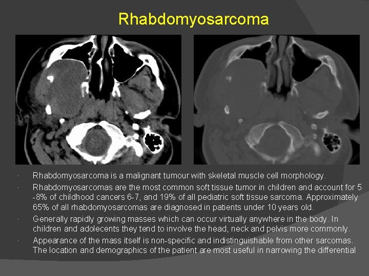 Rhabdomyosarcoma is a malignant tumour with skeletal muscle cell morphology. Rhabdomyosarcomas are the most