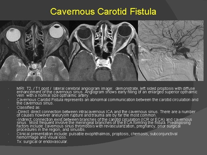 Cavernous Carotid Fistula MRI: T 2, / T 1 post / lateral cerebral angiogram