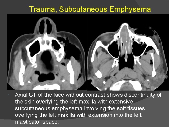 Trauma, Subcutaneous Emphysema Axial CT of the face without contrast shows discontinuity of the