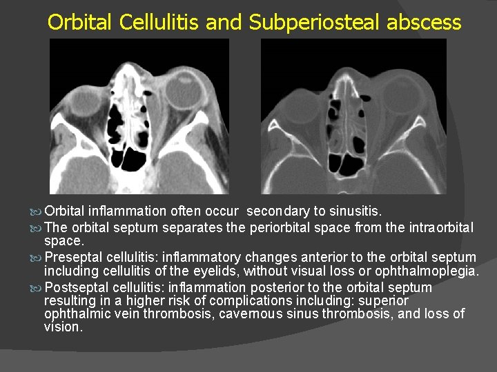 Orbital Cellulitis and Subperiosteal abscess Orbital inflammation often occur secondary to sinusitis. The orbital