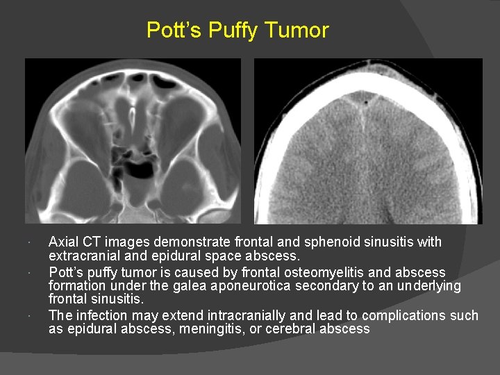 Pott’s Puffy Tumor Axial CT images demonstrate frontal and sphenoid sinusitis with extracranial and