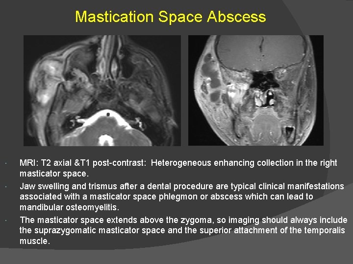 Mastication Space Abscess MRI: T 2 axial &T 1 post-contrast: Heterogeneous enhancing collection in