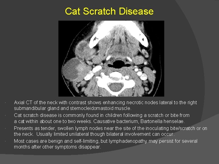 Cat Scratch Disease Axial CT of the neck with contrast shows enhancing necrotic nodes