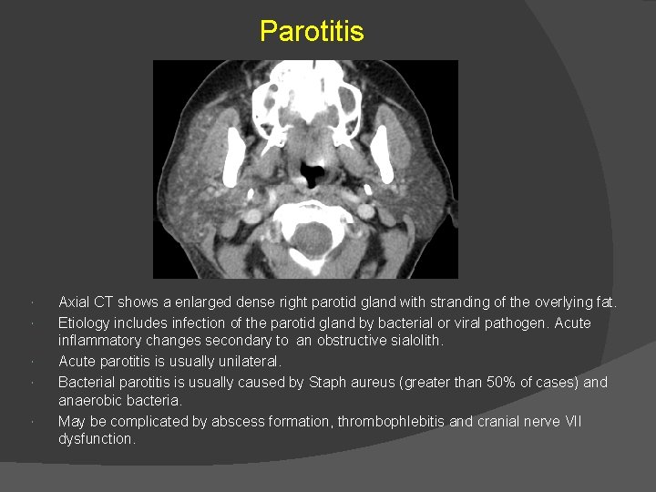 Parotitis Axial CT shows a enlarged dense right parotid gland with stranding of the