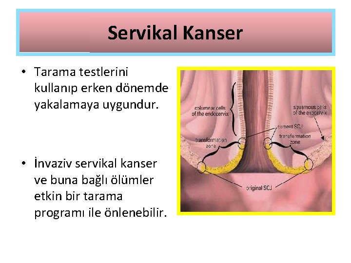 Servikal Kanser • Tarama testlerini kullanıp erken dönemde yakalamaya uygundur. • İnvaziv servikal kanser