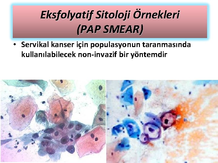 Eksfolyatif Sitoloji Örnekleri (PAP SMEAR) • Servikal kanser için populasyonun taranmasında kullanılabilecek non-invazif bir