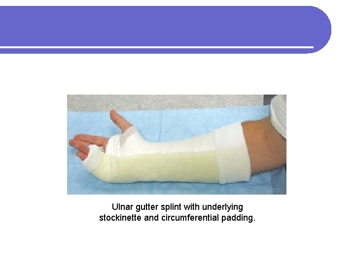 Ulnar gutter splint with underlying stockinette and circumferential padding. 