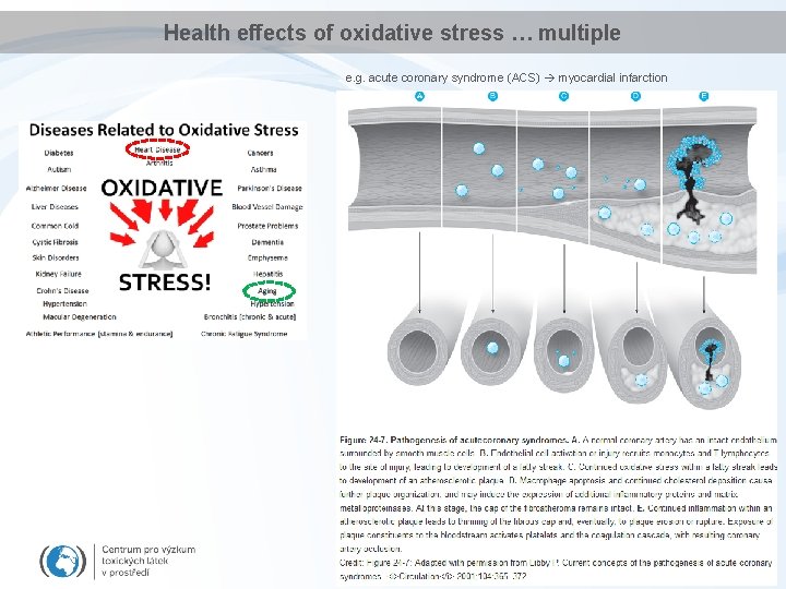 Health effects of oxidative stress … multiple e. g. acute coronary syndrome (ACS) myocardial