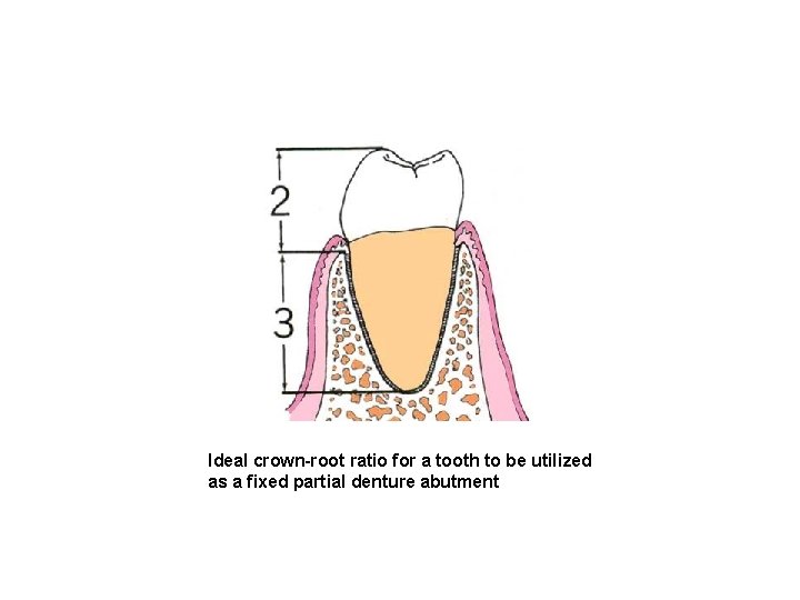 Ideal crown-root ratio for a tooth to be utilized as a fixed partial denture