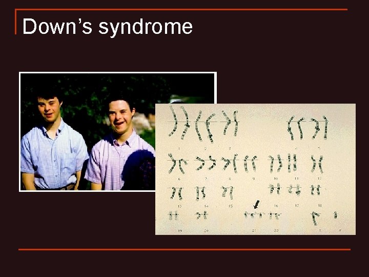 Down’s syndrome Down’s syndrome