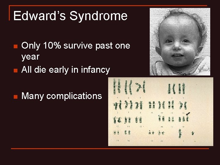 Edward’s Syndrome n Only 10% survive past one year All die early in infancy Edward’s Syndrome n Only 10% survive past one year All die early in infancy