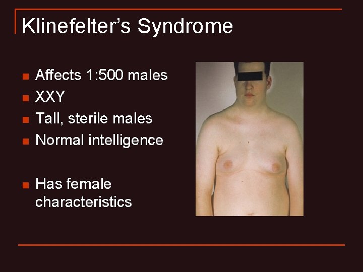 Klinefelter’s Syndrome n n n Affects 1: 500 males XXY Tall, sterile males Normal Klinefelter’s Syndrome n n n Affects 1: 500 males XXY Tall, sterile males Normal