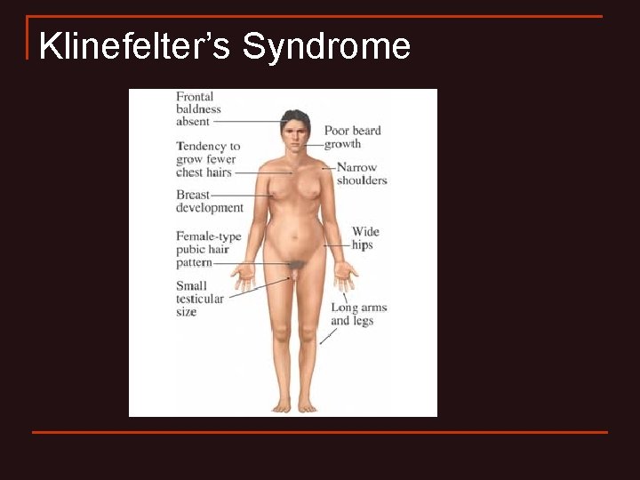 Klinefelter’s Syndrome Klinefelter’s Syndrome