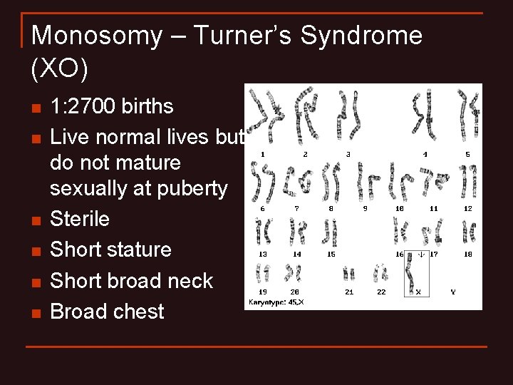 Monosomy – Turner’s Syndrome (XO) n n n 1: 2700 births Live normal lives Monosomy – Turner’s Syndrome (XO) n n n 1: 2700 births Live normal lives