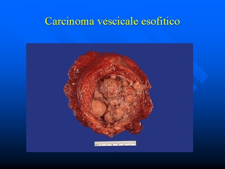 Carcinoma vescicale esofitico 