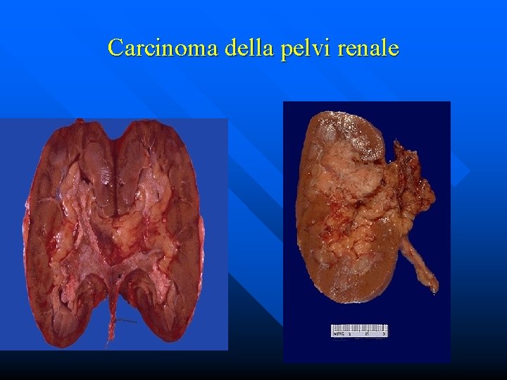 Carcinoma della pelvi renale 