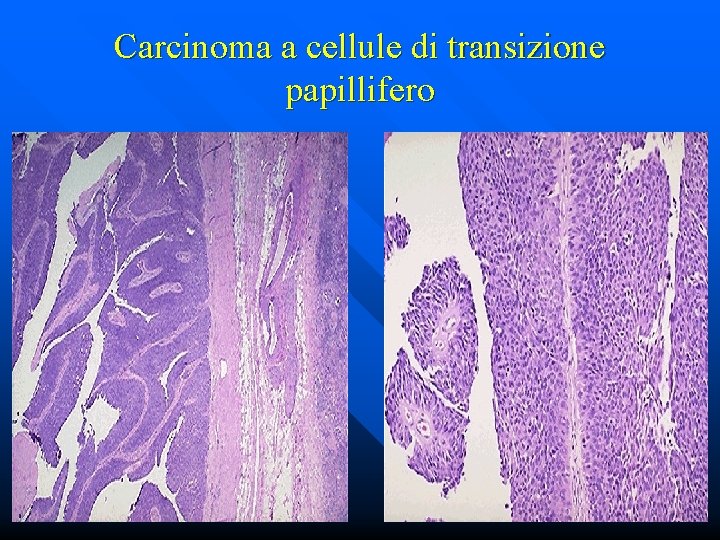 Carcinoma a cellule di transizione papillifero 