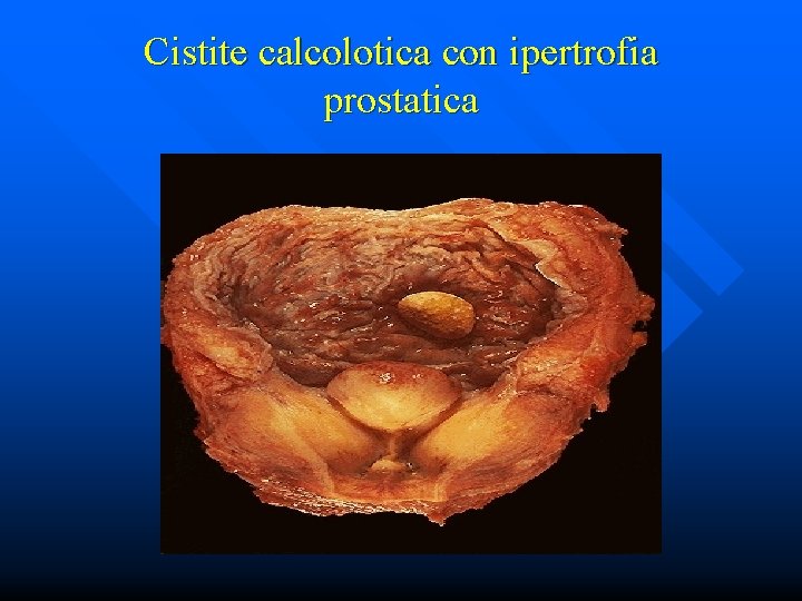 Cistite calcolotica con ipertrofia prostatica 