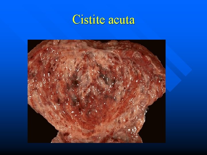 Cistite acuta 