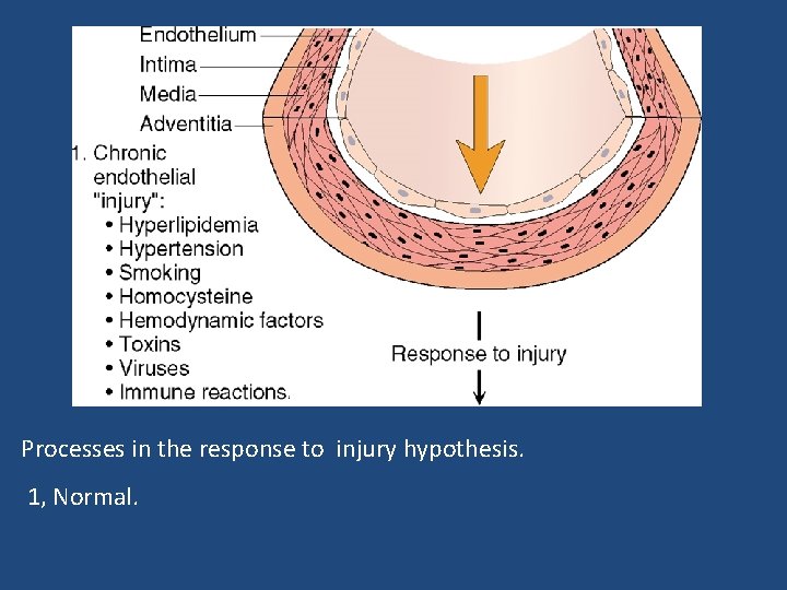 Processes in the response to injury hypothesis. 1, Normal. 