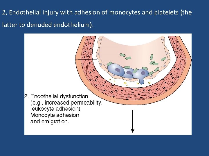 2, Endothelial injury with adhesion of monocytes and platelets (the latter to denuded endothelium).