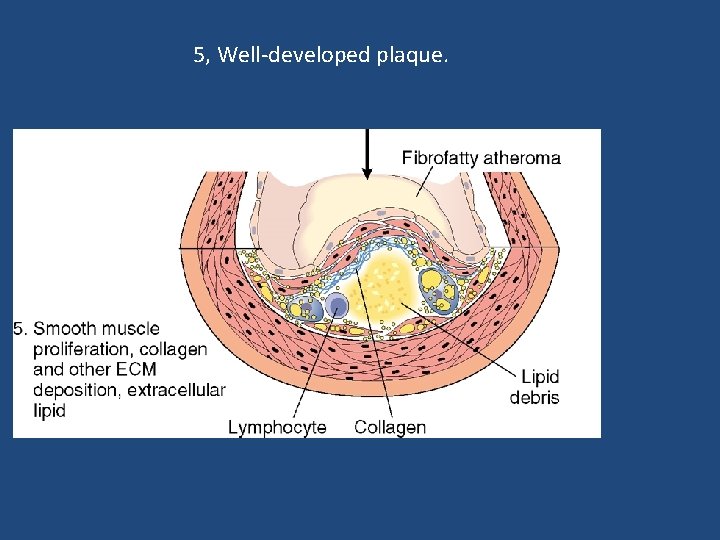 5, Well-developed plaque. 