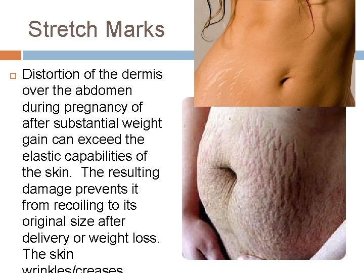 Stretch Marks Distortion of the dermis over the abdomen during pregnancy of after substantial