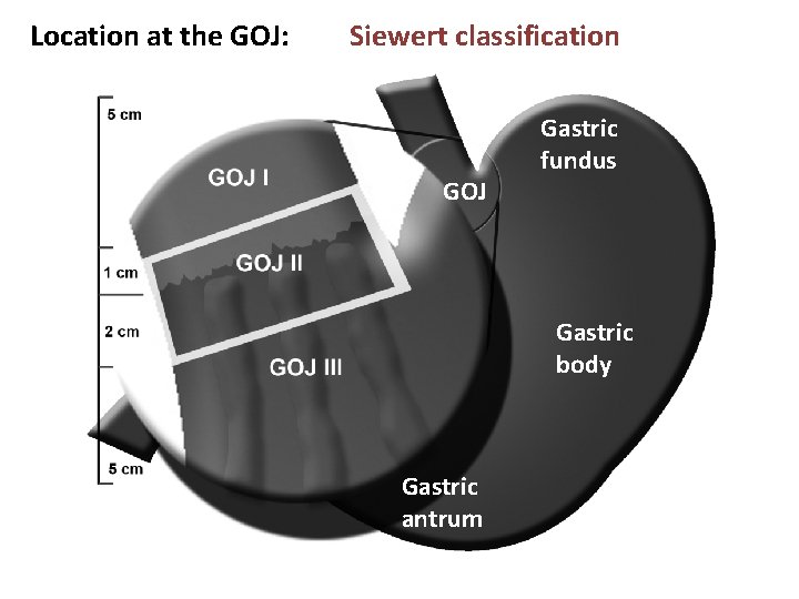 Location at the GOJ: Siewert classification GOJ Gastric fundus Gastric body Gastric antrum 