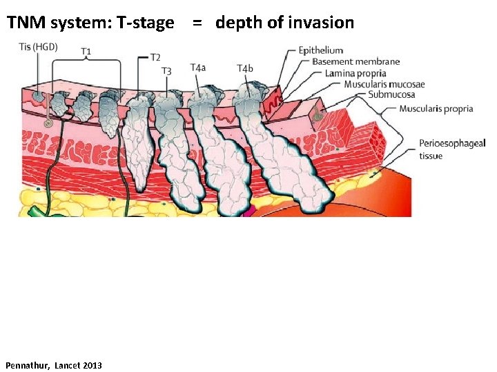 TNM system: T-stage = depth of invasion Pennathur, Lancet 2013 