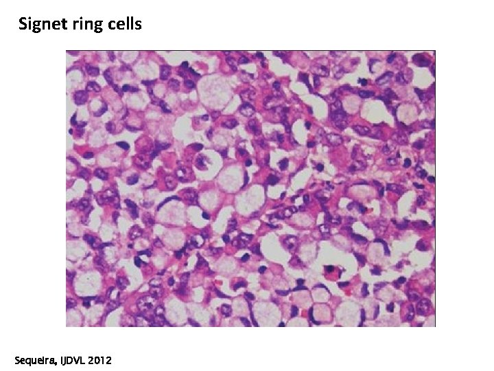 Signet ring cells Sequeira, IJDVL 2012 