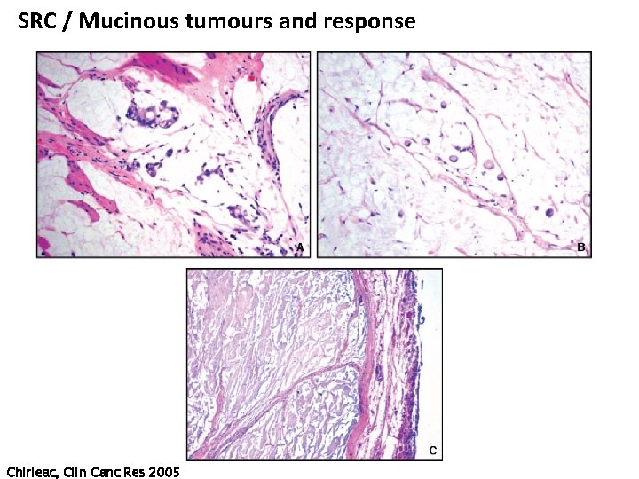 SRC / Mucinous tumours and response Chirieac, Clin Canc Res 2005 