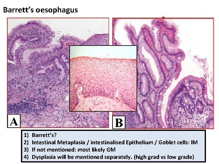 Barrett’s oesophagus 1) 2) 3) 4) Barrett’s? Intestinal Metaplasia / intestinalised Epithelium / Goblet