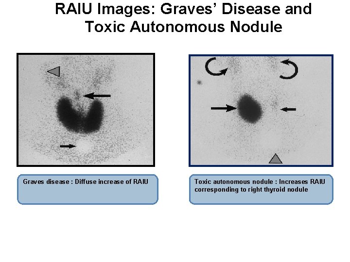 RAIU Images: Graves’ Disease and Toxic Autonomous Nodule Graves disease : Diffuse increase of