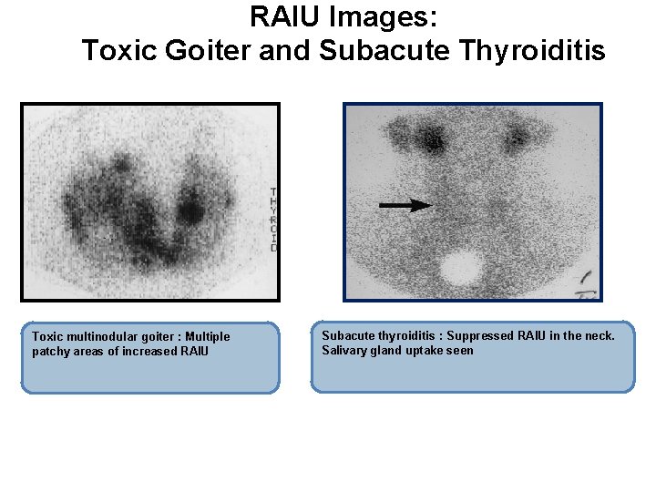 RAIU Images: Toxic Goiter and Subacute Thyroiditis Toxic multinodular goiter : Multiple patchy areas