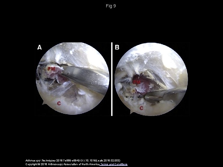 Fig 9 Arthroscopy Techniques 2018 7 e 589 -e 594 DOI: (10. 1016/j. eats.