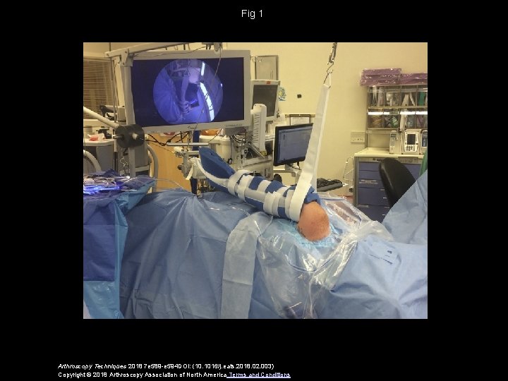 Fig 1 Arthroscopy Techniques 2018 7 e 589 -e 594 DOI: (10. 1016/j. eats.