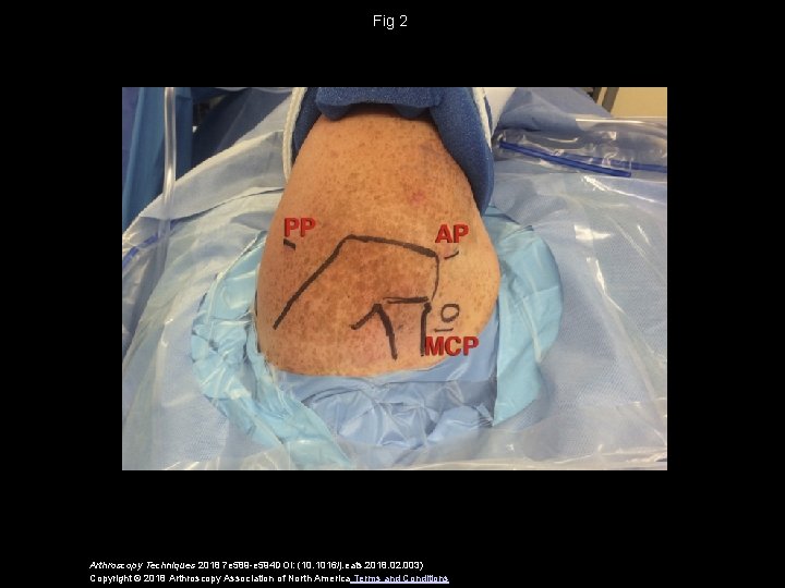 Fig 2 Arthroscopy Techniques 2018 7 e 589 -e 594 DOI: (10. 1016/j. eats.