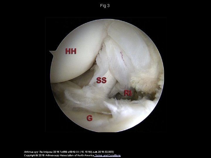 Fig 3 Arthroscopy Techniques 2018 7 e 589 -e 594 DOI: (10. 1016/j. eats.