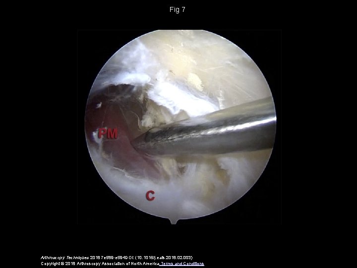 Fig 7 Arthroscopy Techniques 2018 7 e 589 -e 594 DOI: (10. 1016/j. eats.