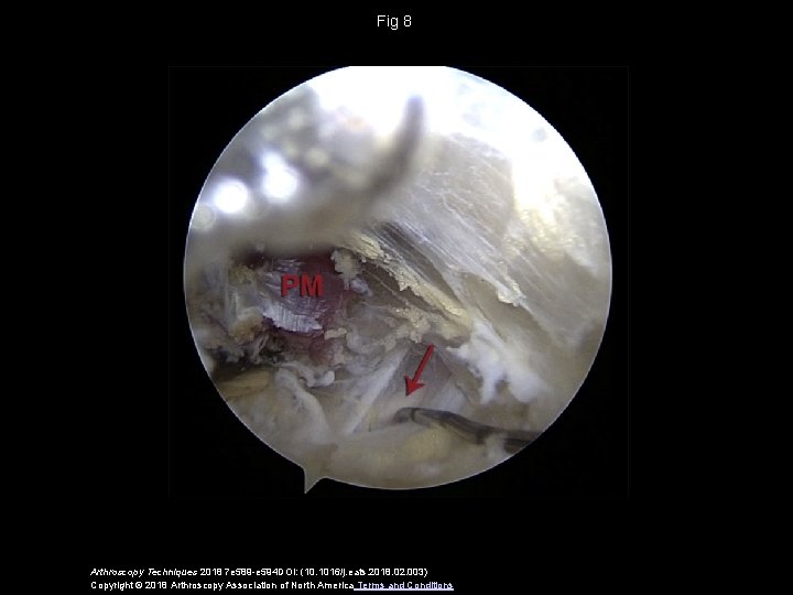 Fig 8 Arthroscopy Techniques 2018 7 e 589 -e 594 DOI: (10. 1016/j. eats.