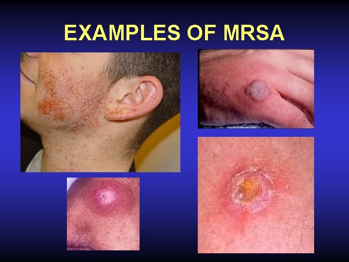EXAMPLES OF MRSA 