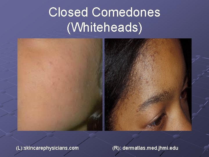 Closed Comedones (Whiteheads) (L): skincarephysicians. com (R): dermatlas. med. jhmi. edu 