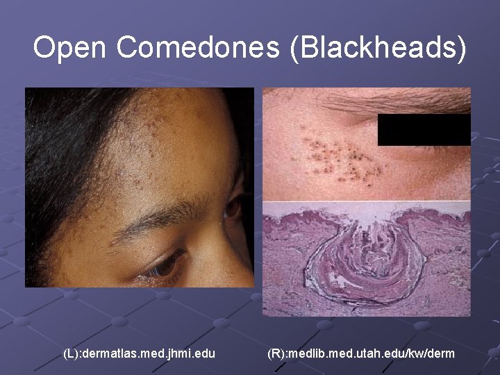 Open Comedones (Blackheads) (L): dermatlas. med. jhmi. edu (R): medlib. med. utah. edu/kw/derm 